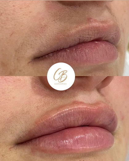 lip filler