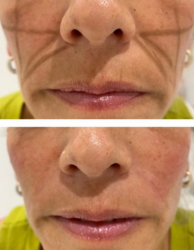 Dermal fillers used for cheek augmentation