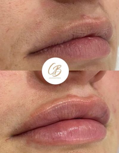 Lip Augmentation