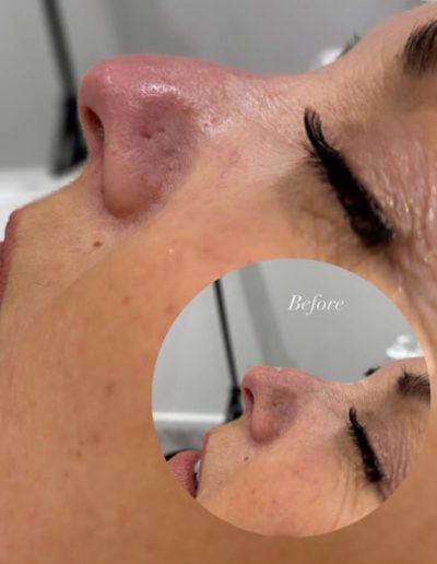 Non Surgical Rhinoplasty