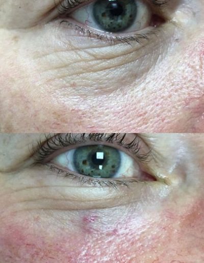 Tear Trough Treatment