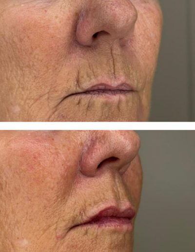 Upper Lip Augmentation