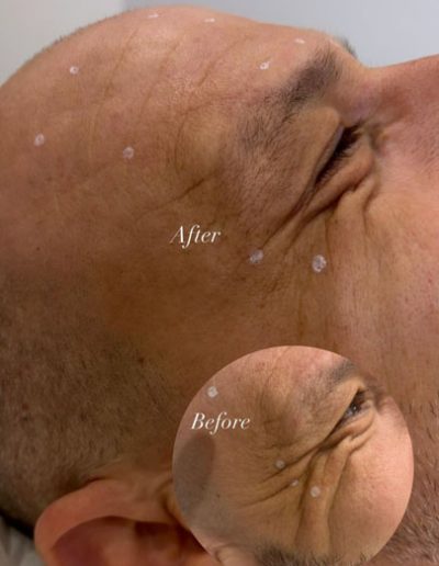 muscle relaxing treatments for wrinkle reduction