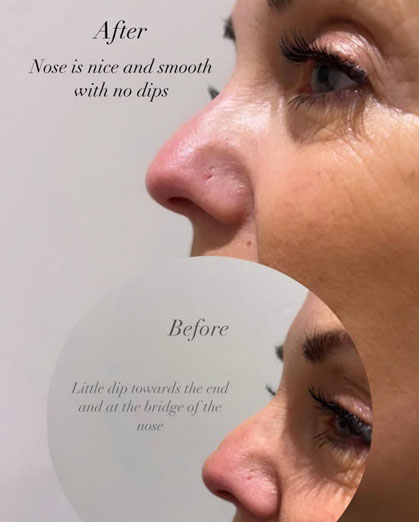 non-surgical rhinoplasty